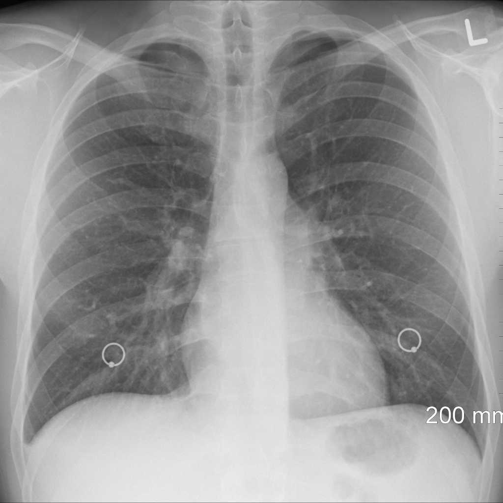 Chest Wall Deformities